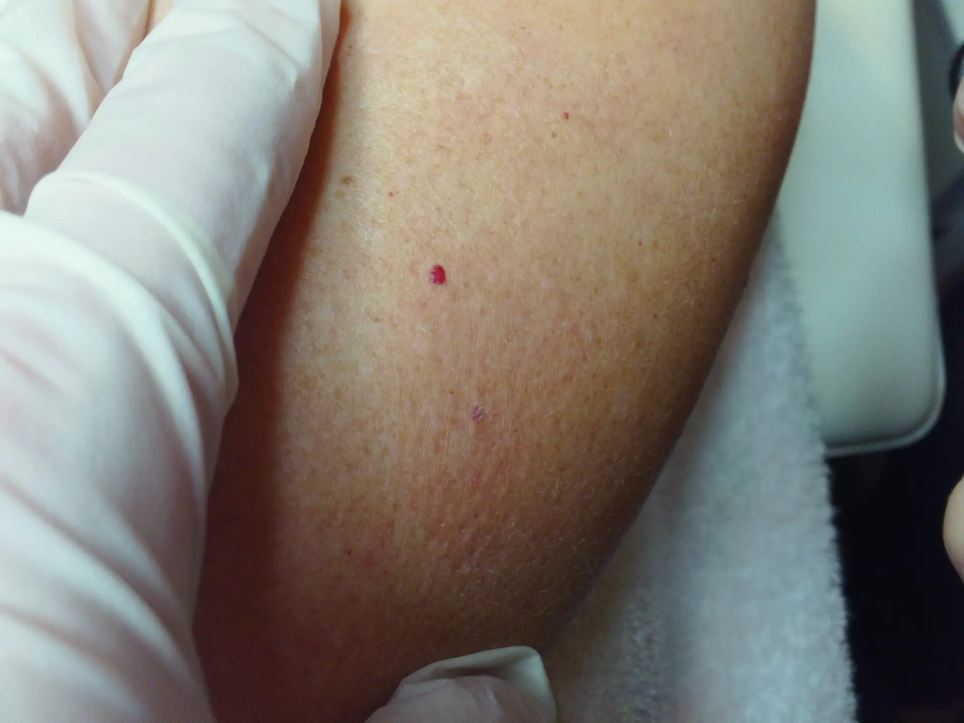 ORAJA_beauty_&_wellness_behandeling_bloedblaasjes_weg_Varigone
